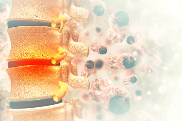 Bone cancer detailed